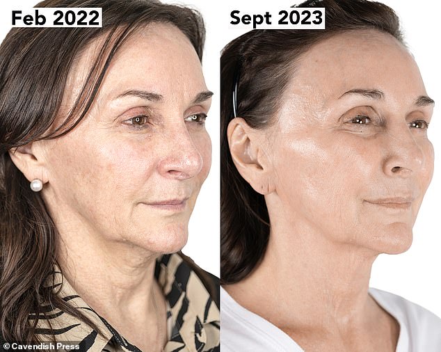 Shirley has thanked her non-surgical facelift for restoring her glow after she admitted the visible signs of aging had affected her confidence and left her feeling depressed.